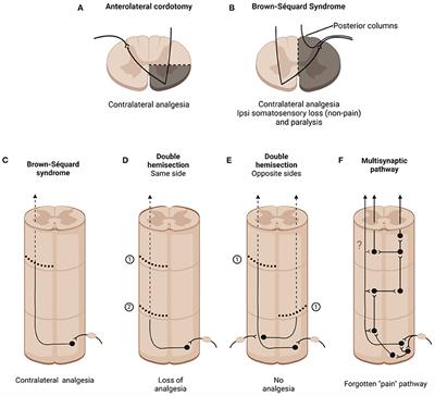 History of Spinal Cord “Pain” Pathways Including the Pathways Not Taken